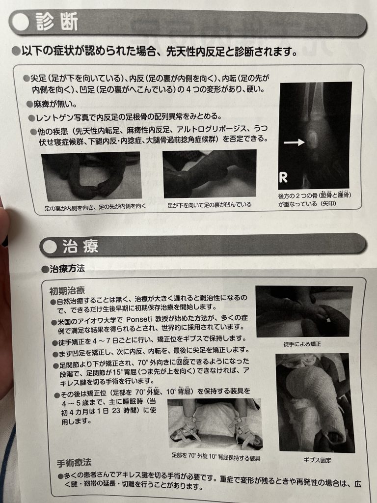 先天性内反足の診断2