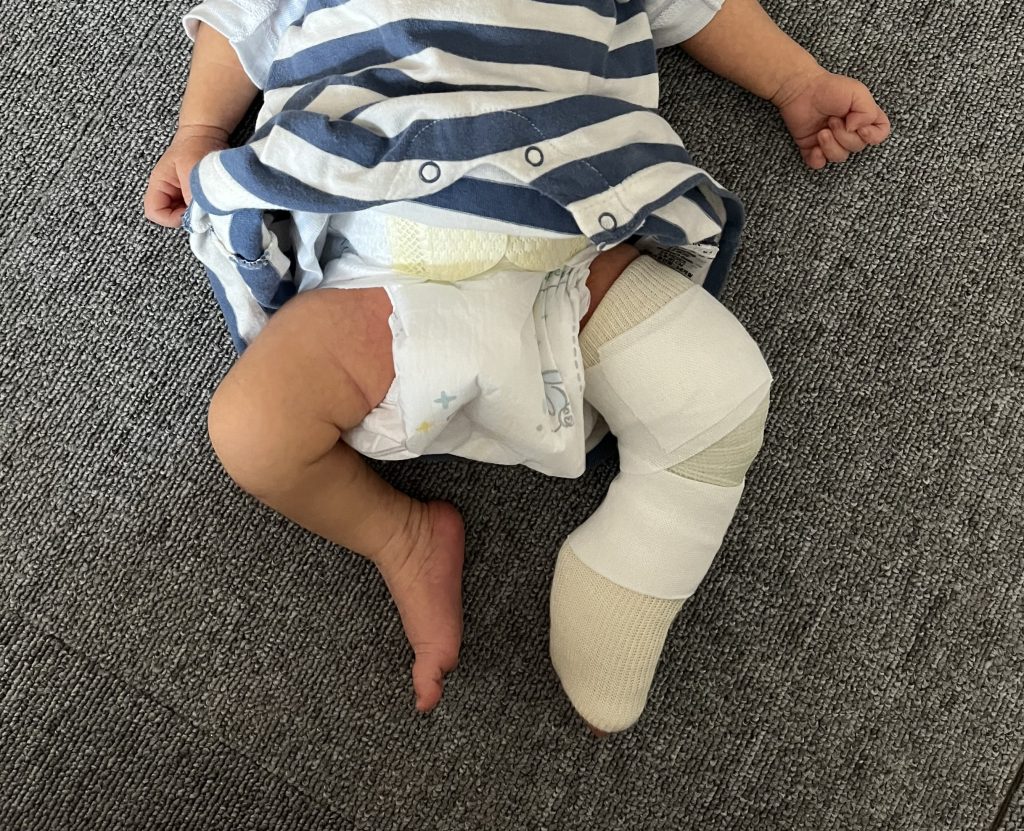 初めてのギプス巻き1