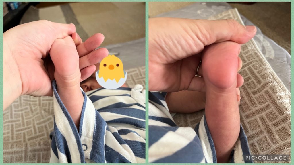 ギプス矯正の経過4