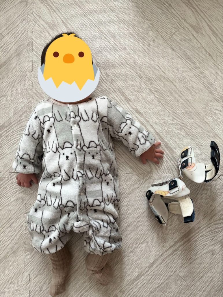 装具を外して解放感？