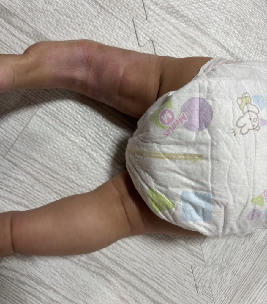 皮膚トラブルの状態