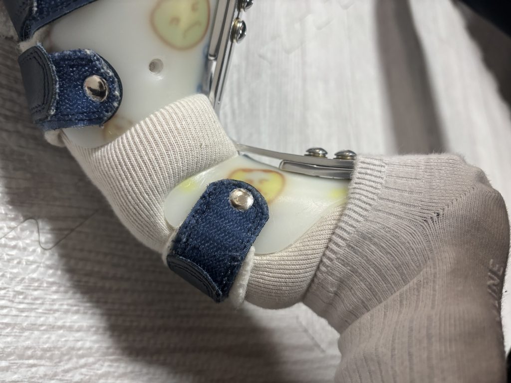 金具の食い込み1