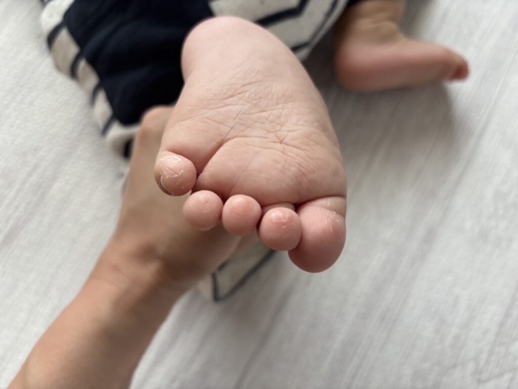 指の皮がむけた