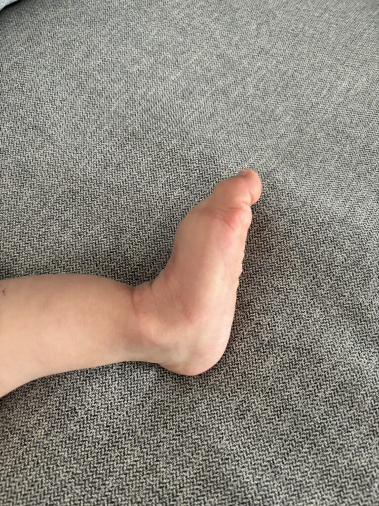 1歳半_足の状態2