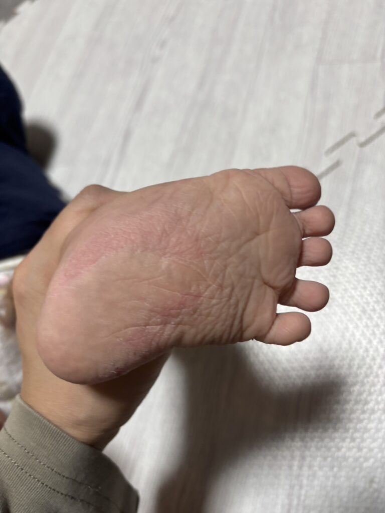 足裏しわしわ