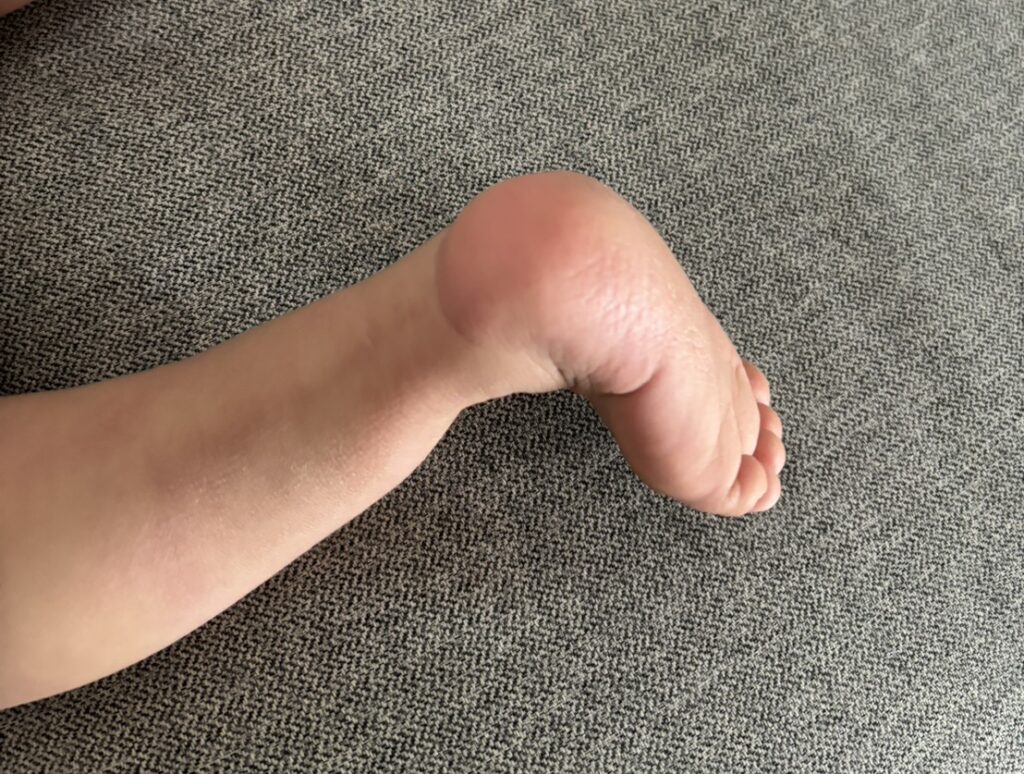 1歳半_足の状態4