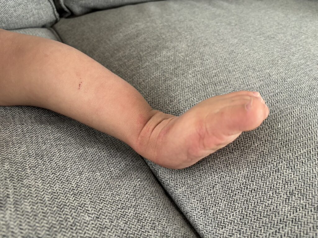 1歳半_足の状態5