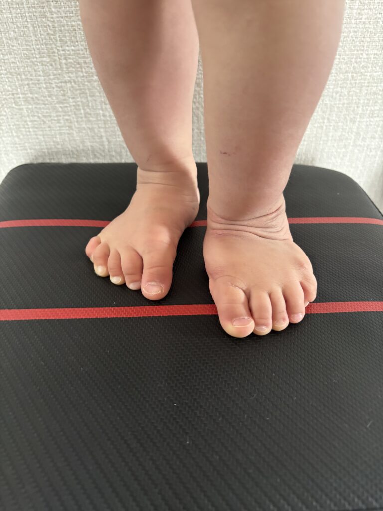 1歳半_足の状態8