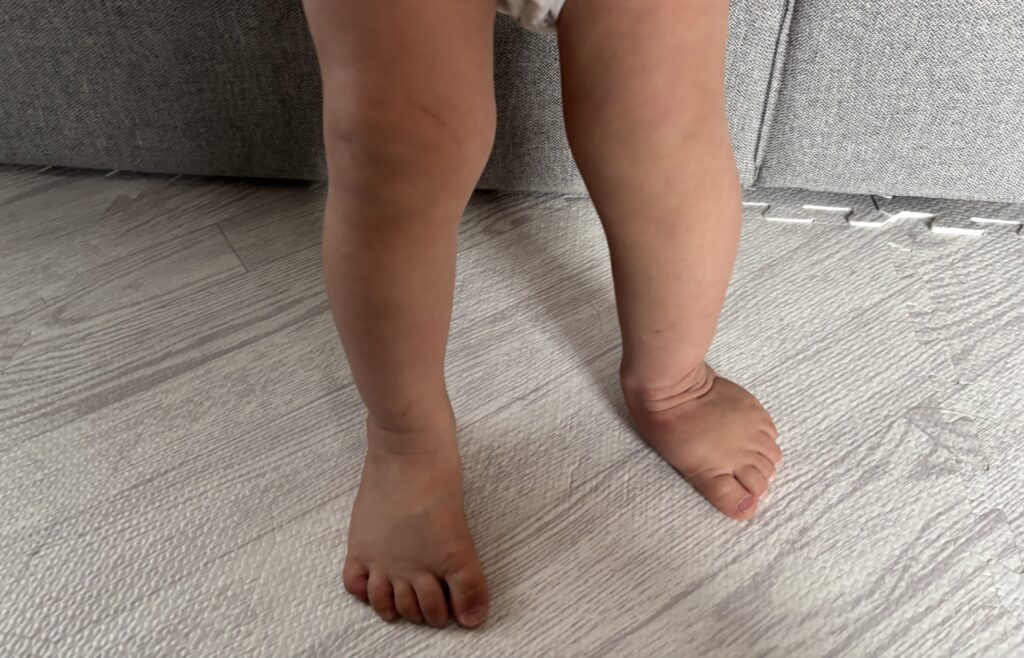 1歳半_足の状態7